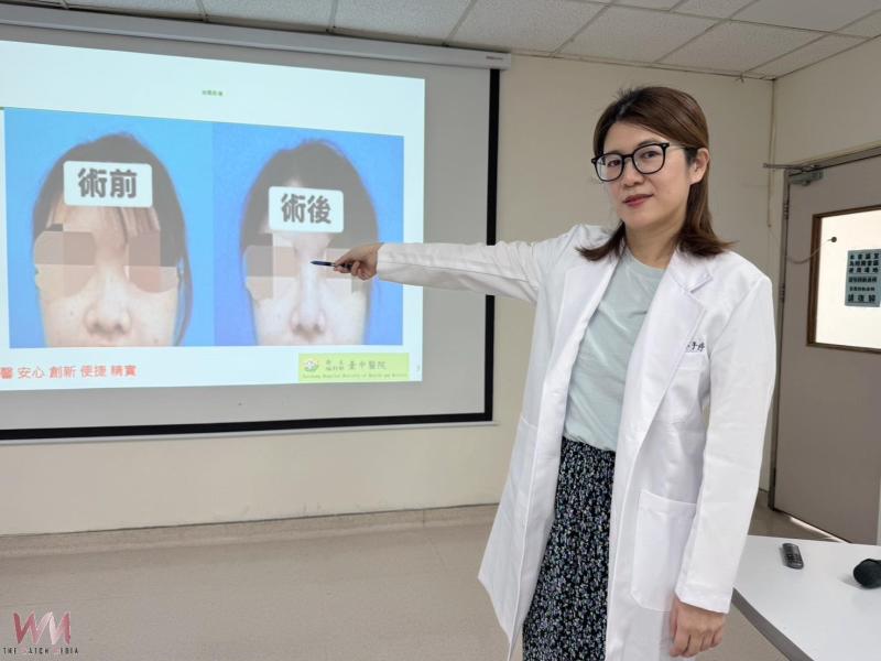 蘋果姐姐遇車禍撞歪鼻子 自體肋軟骨重建堅挺鼻樑 順暢呼吸重拾自信 - https://www.watchmedia01.com