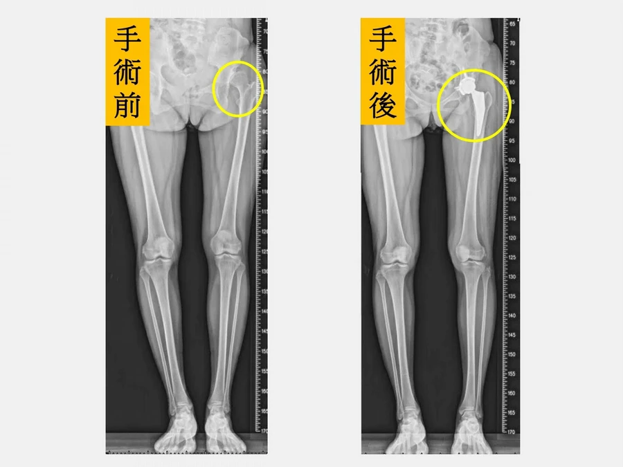 微創髖關節置換手術恢復快