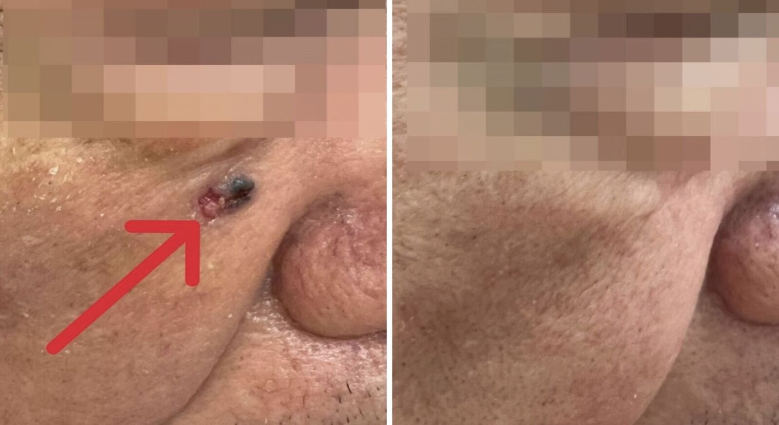 男臉上冒黑斑「不痛不癢」 再一看長大了！竟是皮膚基底細胞癌 223