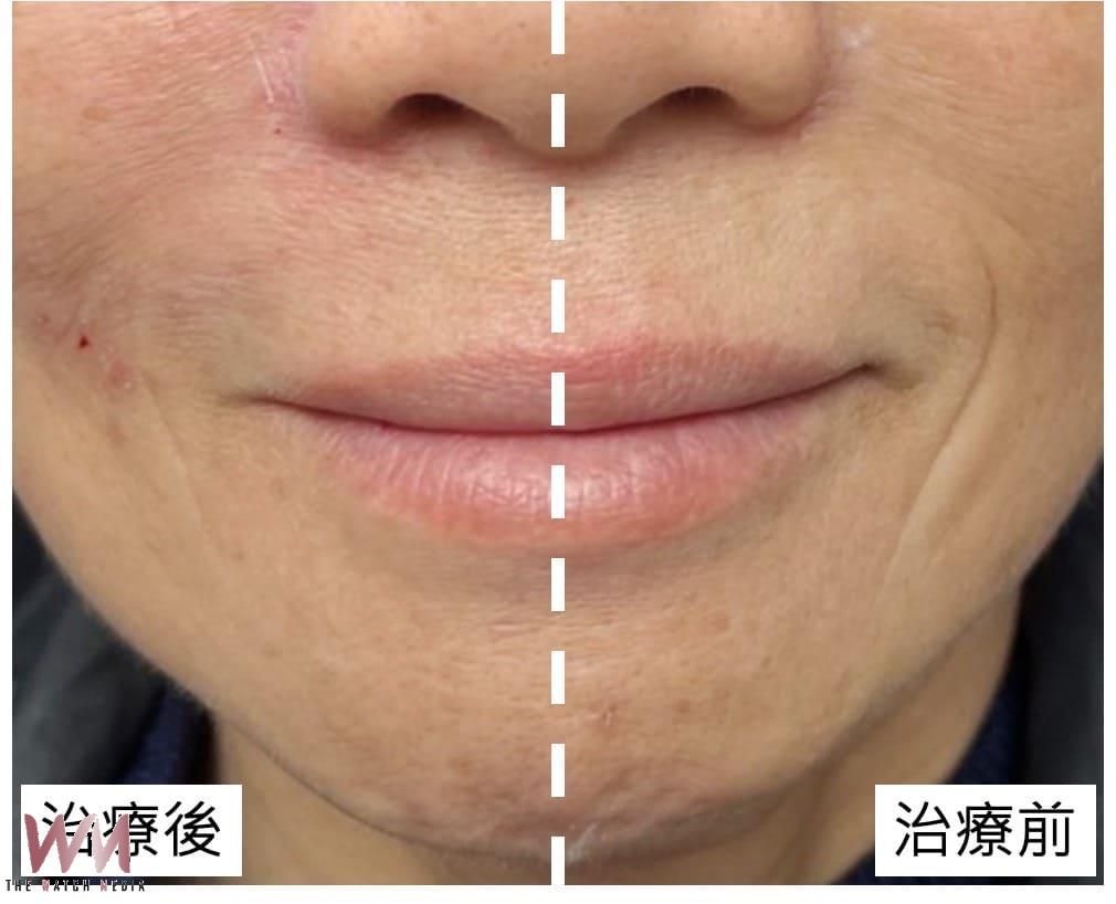 中年女臉部皺紋顯疲態 皮膚科醫師教你破解歲月痕跡 展現自信之美 - https://www.watchmedia01.com