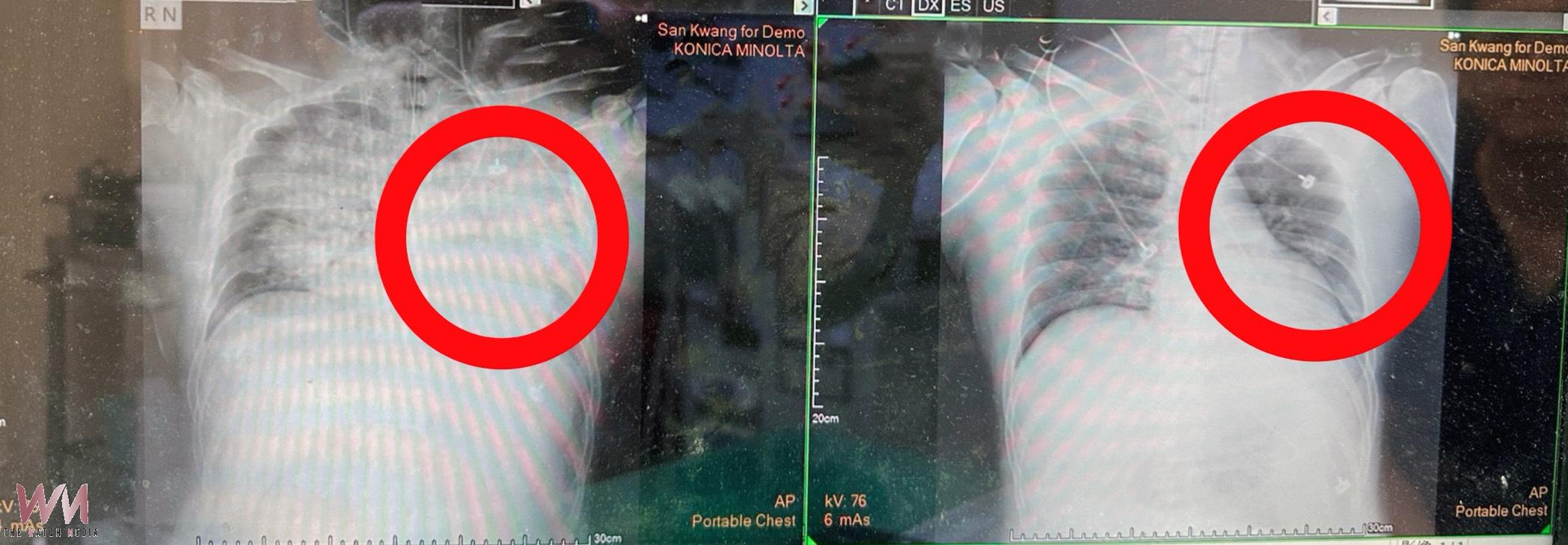 一口珍奶嗆咳秒昏迷 醫警覺異常揪出腦血管瘤破裂 啟動引流及葉克膜搶命 - https://www.watchmedia01.com