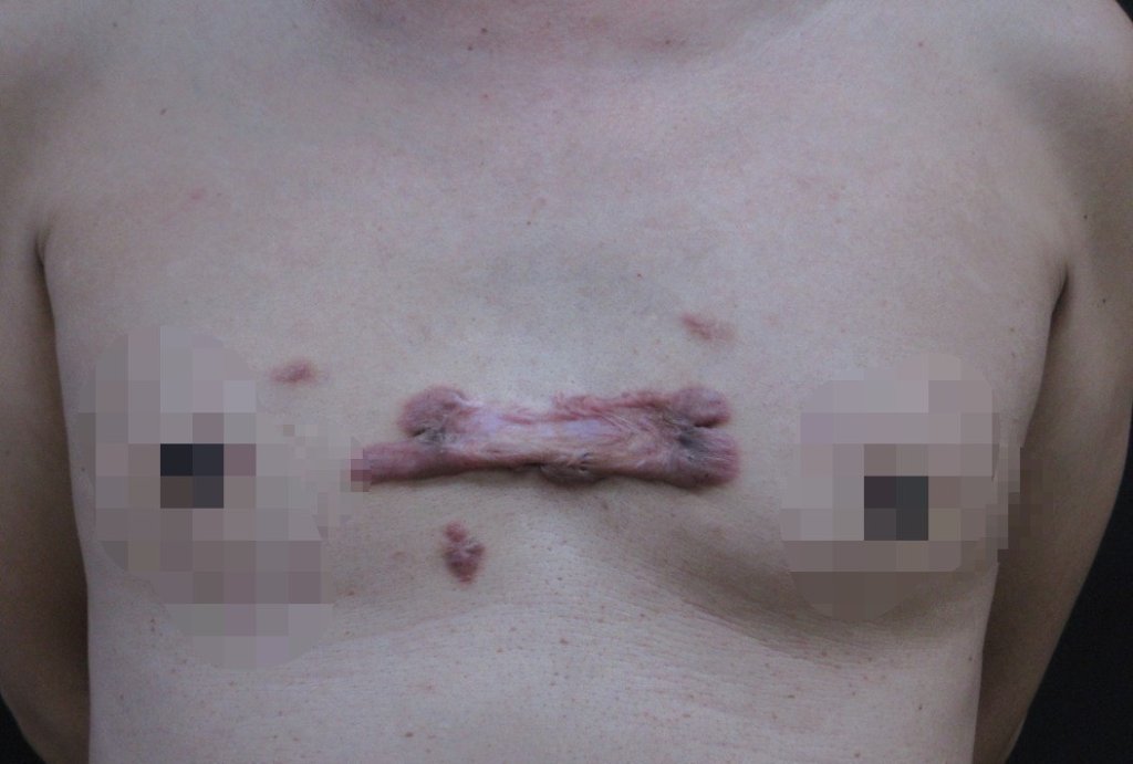 青春痘捏破異常增生成「蟹足腫」-整形外科以羊膜生長因子治療改善