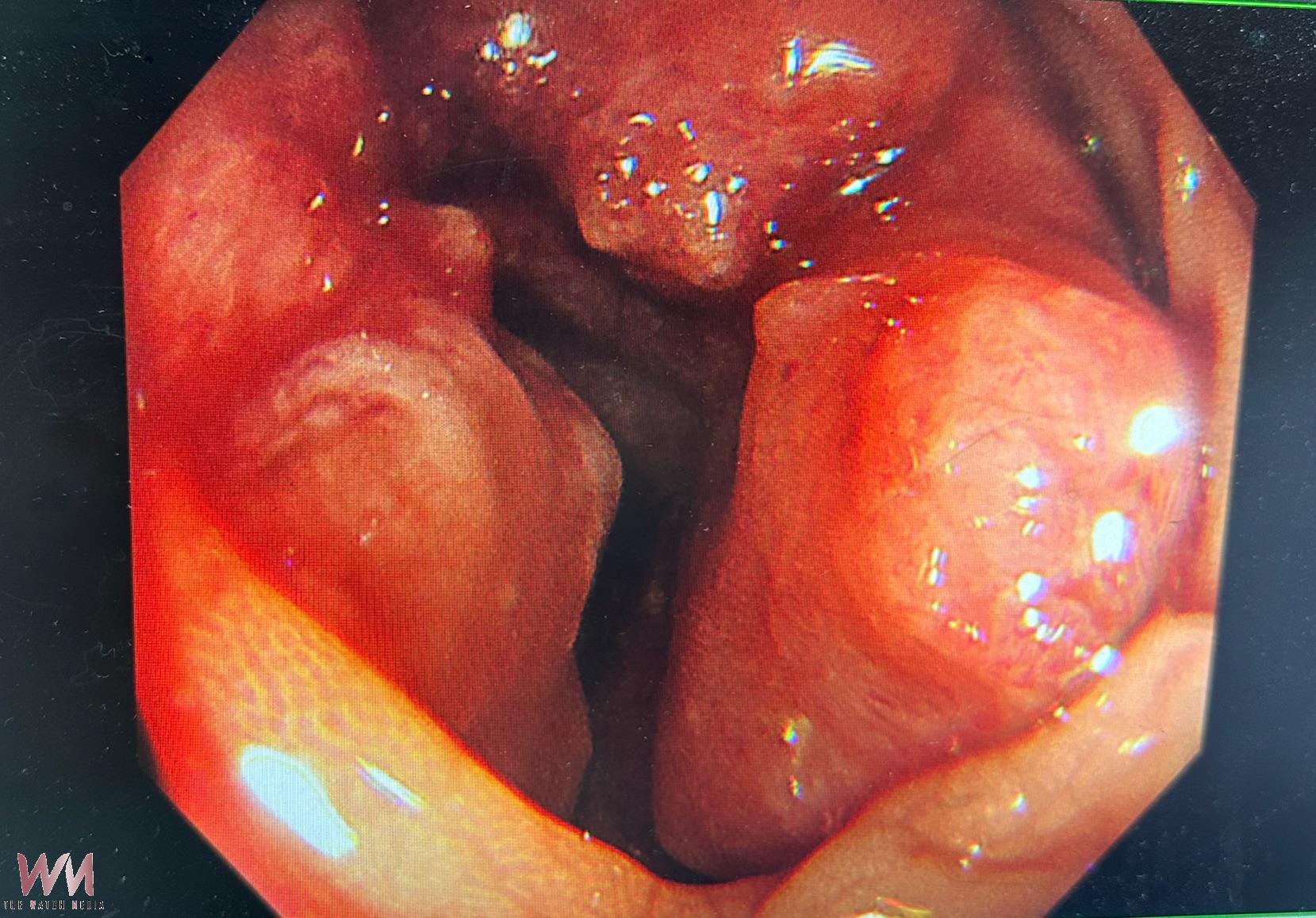 大腸腫瘤有年輕化趨勢　44歲男血便誤當痔瘡 未達篩檢年齡一照竟是大腸癌 - https://www.watchmedia01.com
