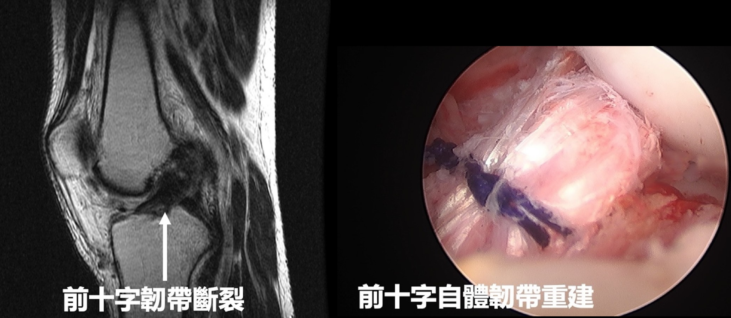 出國滑雪必看!跌倒恐害前十字韌帶斷裂 醫籲出發前先做這事 1253 1 scaled