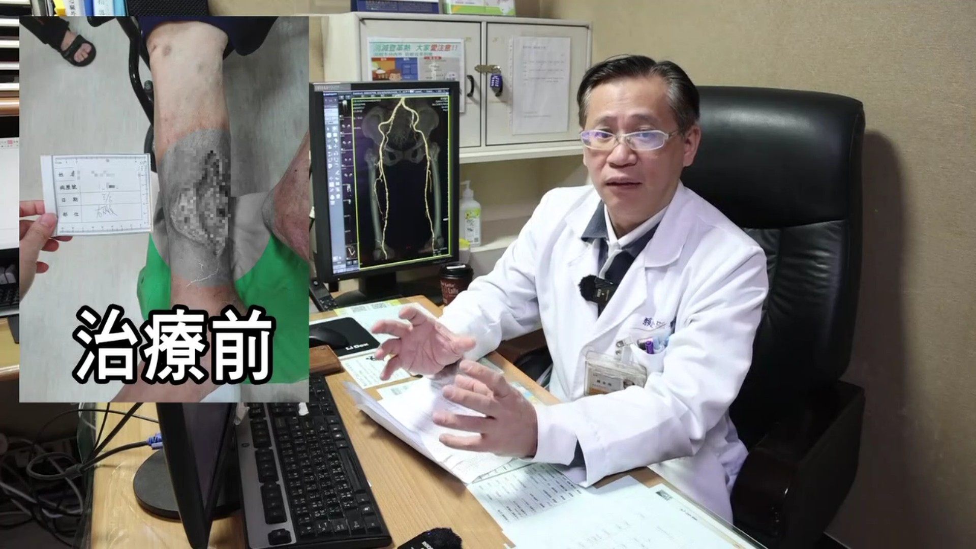 （有影片）／慢性傷口久未癒合　心臟外科主任揪出「血液循環雙重障礙」