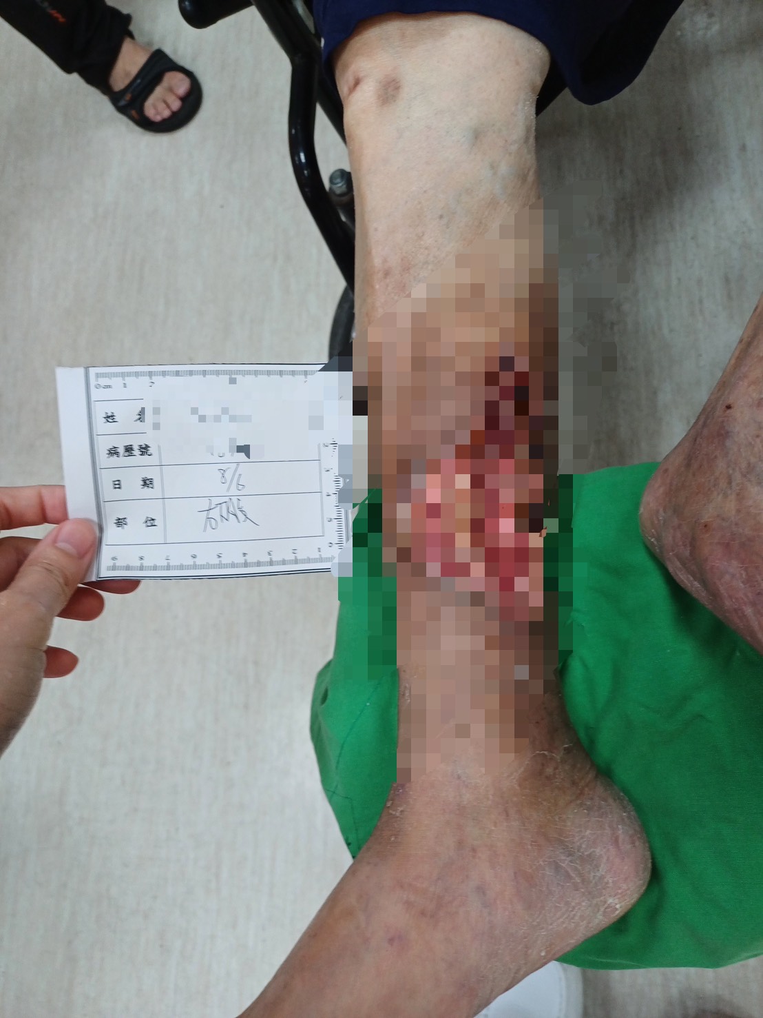 （有影片）／慢性傷口久未癒合　心臟外科主任揪出「血液循環雙重障礙」 - https://www.watchmedia01.com