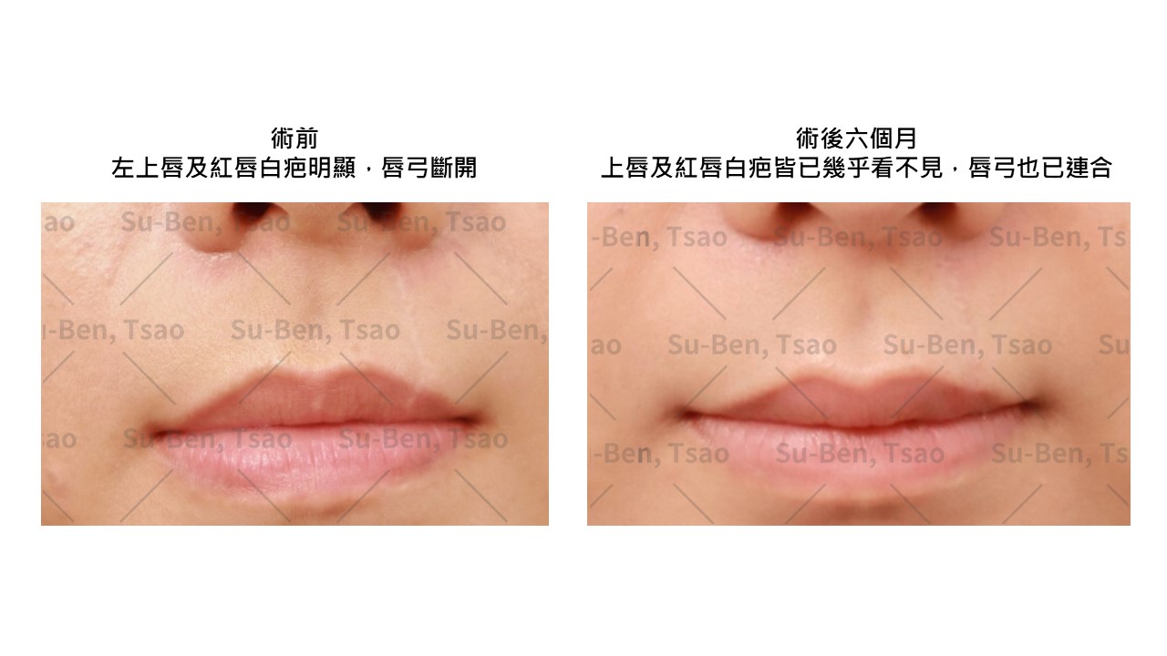 寵物當家抓咬唇部白疤有救 養主重拾失落平安
