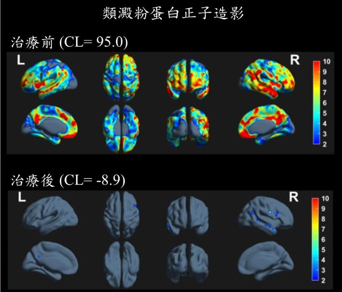 早期治療正向示範 土城醫院公布失智症新藥追蹤成果 44 《圖說》曾敬仁主任指出類澱粉蛋白正子造影檢查顯示,患者治療前(上圖)腦中異常蛋白負荷顯著增加,治療六個月後(下圖)降至正常範圍,反映治療帶來的明顯成效。〈土城醫院提供〉