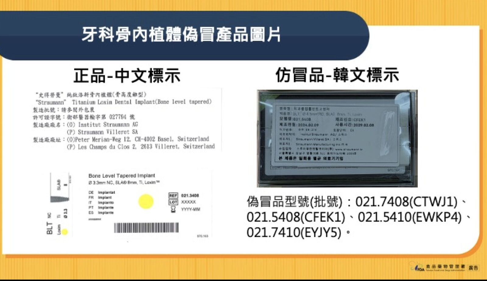 高價植牙有「假」!食藥署查獲仿冒骨內植體 韓文標示4批號曝光 236 高價植牙有「假」!食藥署查獲仿冒骨內植體 韓文標示4批號曝光 235