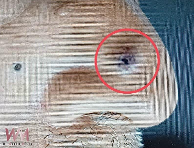 7旬翁鼻上黑點以為是痣拖兩年 明顯變化又出血確認「基底細胞癌」 - https://www.watchmedia01.com