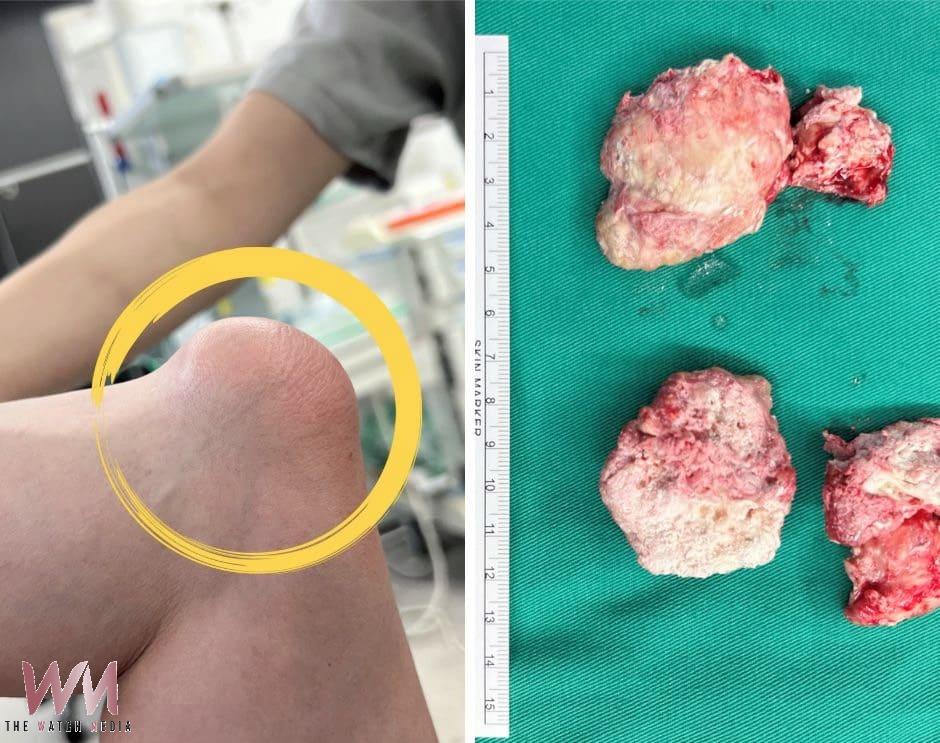 痛風石壓神經釀手麻 微創手術清石助好眠 醫:4狀況及早治 - https://www.watchmedia01.com