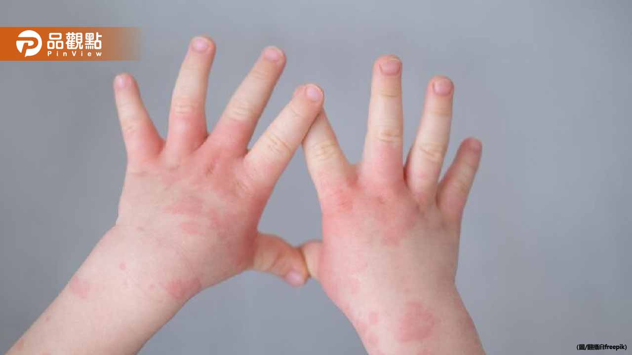 冬天穿錯衣服慘了!兒童紅疹大爆發 醫揭「1款衣物」超母湯