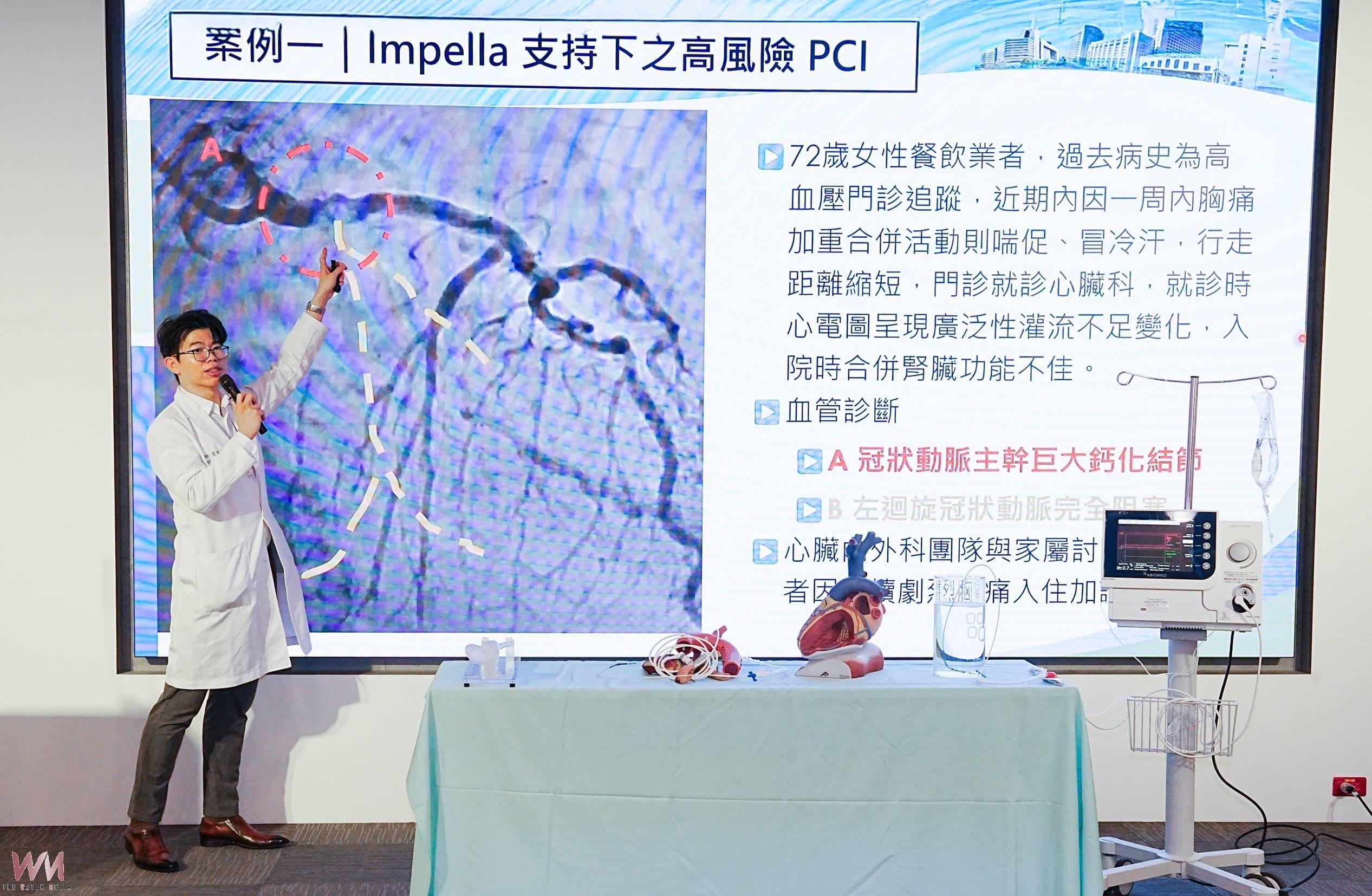 心臟血管「長石頭」險奪命 機械循環輔助助攻 完成高風險心導管治療 - https://www.watchmedia01.com