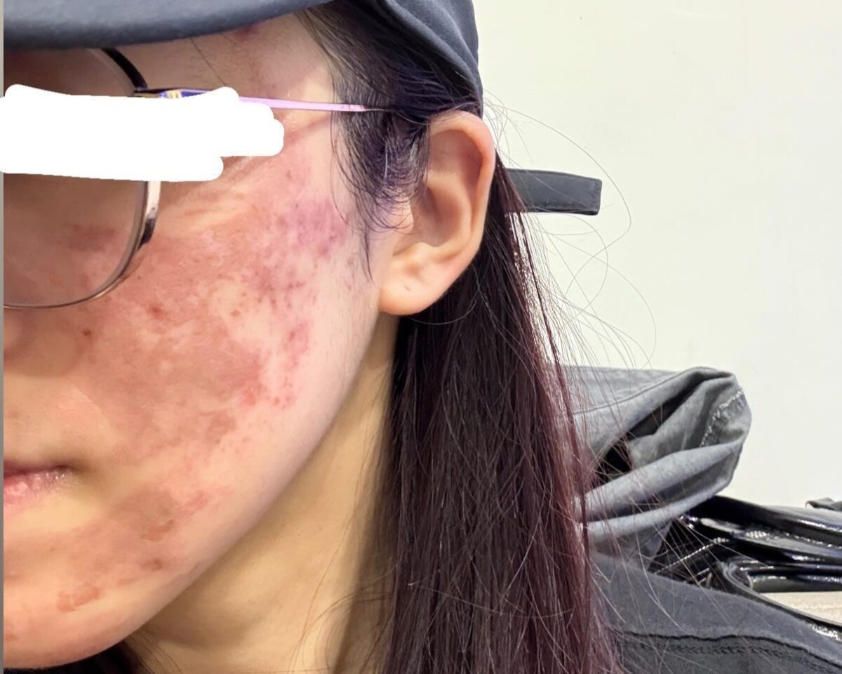 ▲女子到皮膚科診所做果酸換膚,因美容師拿錯濃度造成臉部大面積灼傷。(圖/民眾提供)