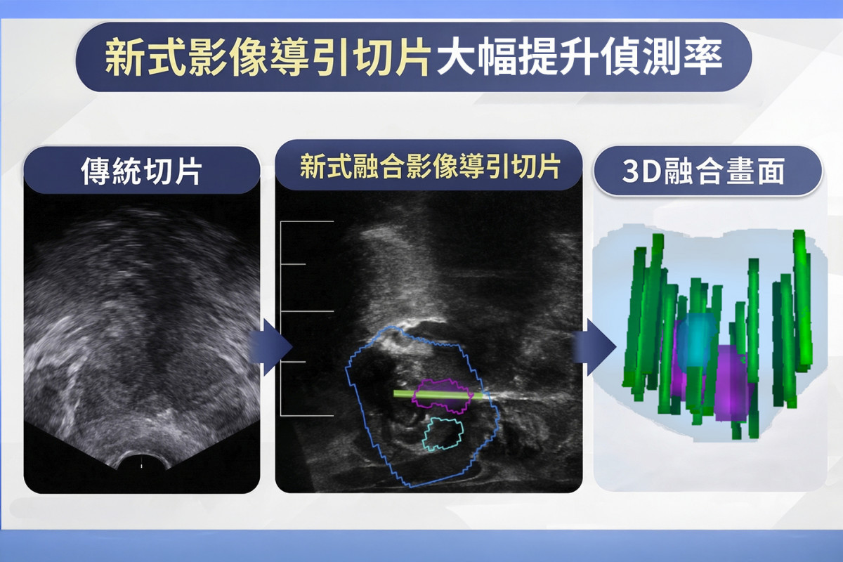 攝護腺癌早期無症狀,傳統切片恐有偽陰性;MRI融合影像導引切片可精準取樣,大幅提升偵測率。圖/彰基醫院提供