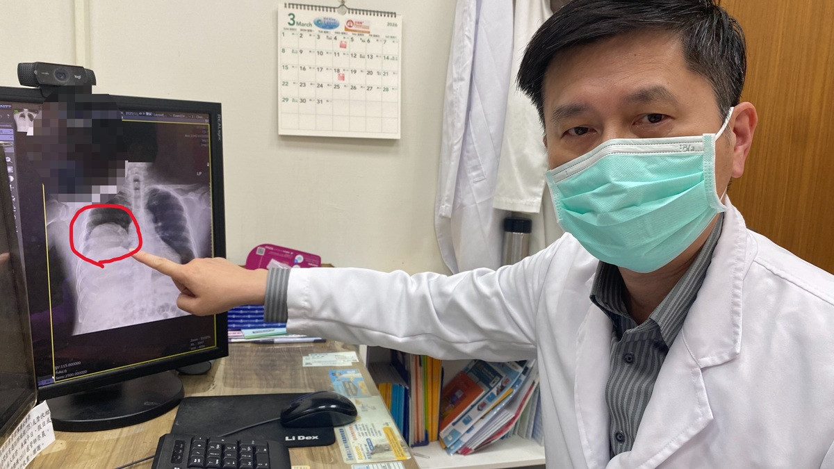 男子多次昏迷送醫,揪出25公分罕見肺腫瘤