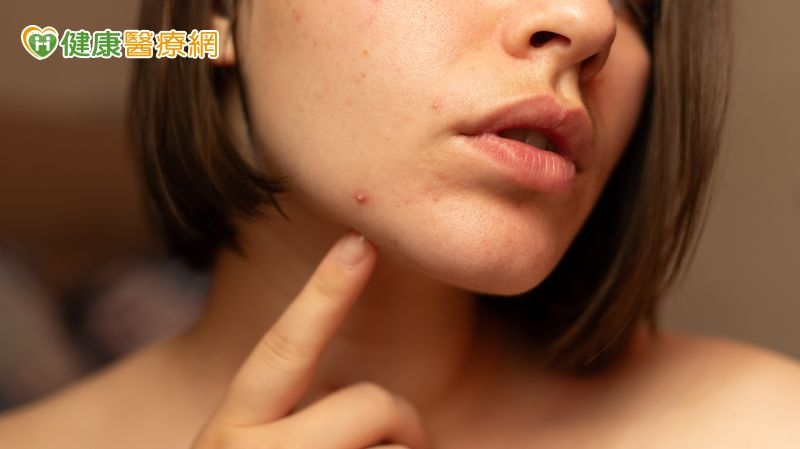 不只青春期!醫:痘痘也困擾上班族、更年期婦女 研究揭僅3成就醫