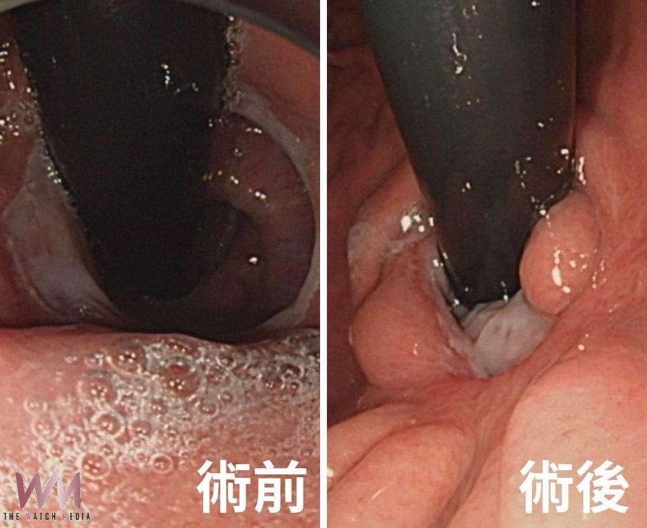 胃食道逆流擾十幾年夜夜難平躺 6旬男接受內視鏡燒灼術 症狀改善睡好眠 - https://www.watchmedia01.com