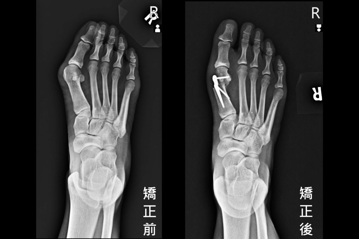 拇趾外翻痛到難行走?聯新國際醫師薛如峯微創手術助6旬婦復原 1 17