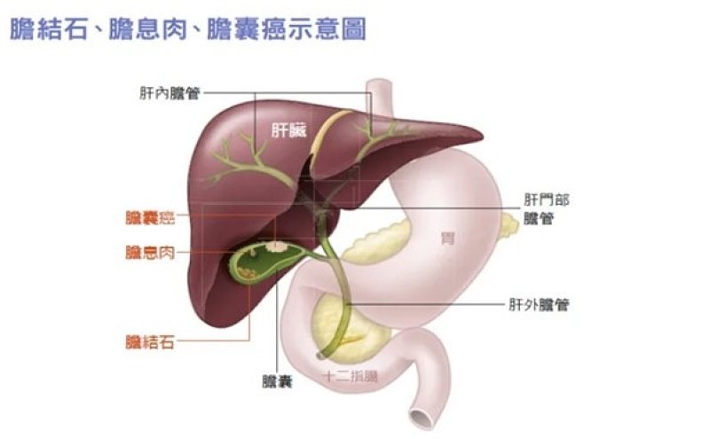體檢發現「膽囊息肉」別慌! 醫揭關鍵尺寸:大於1公分需警覺