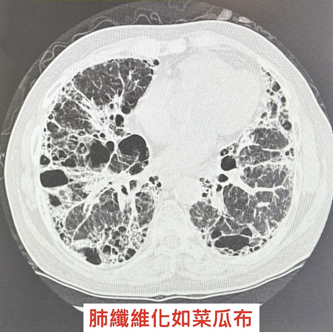 肺部電腦斷層影像顯示肺纖維化情形,肺組織呈現如「菜瓜布」般纖維化變化。(圖/記者張家燁翻攝)