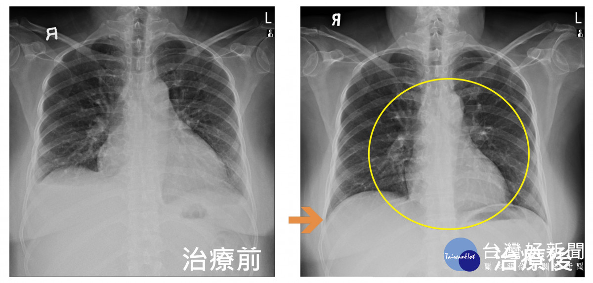 圖左為接受心臟衰竭治療前的x光,心臟擴大與雙側肋膜積水,圖右為接受心衰竭治療後,心臟擴大(黃圈處)與肋膜積水(箭頭處)皆已改善
