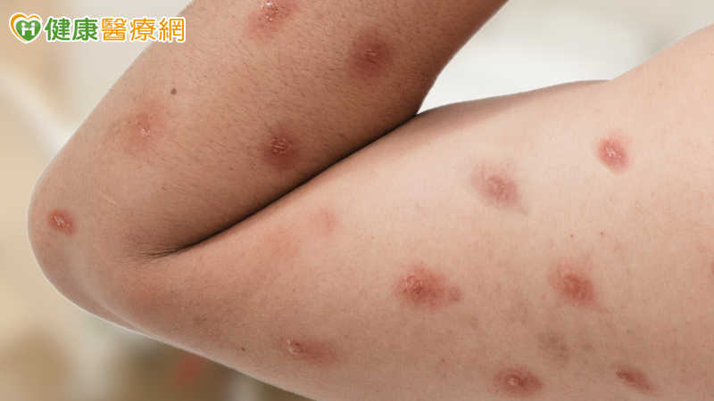 20多歲男染M痘!疾管署:台灣首見Ib型病毒株 小心5大皮膚症狀