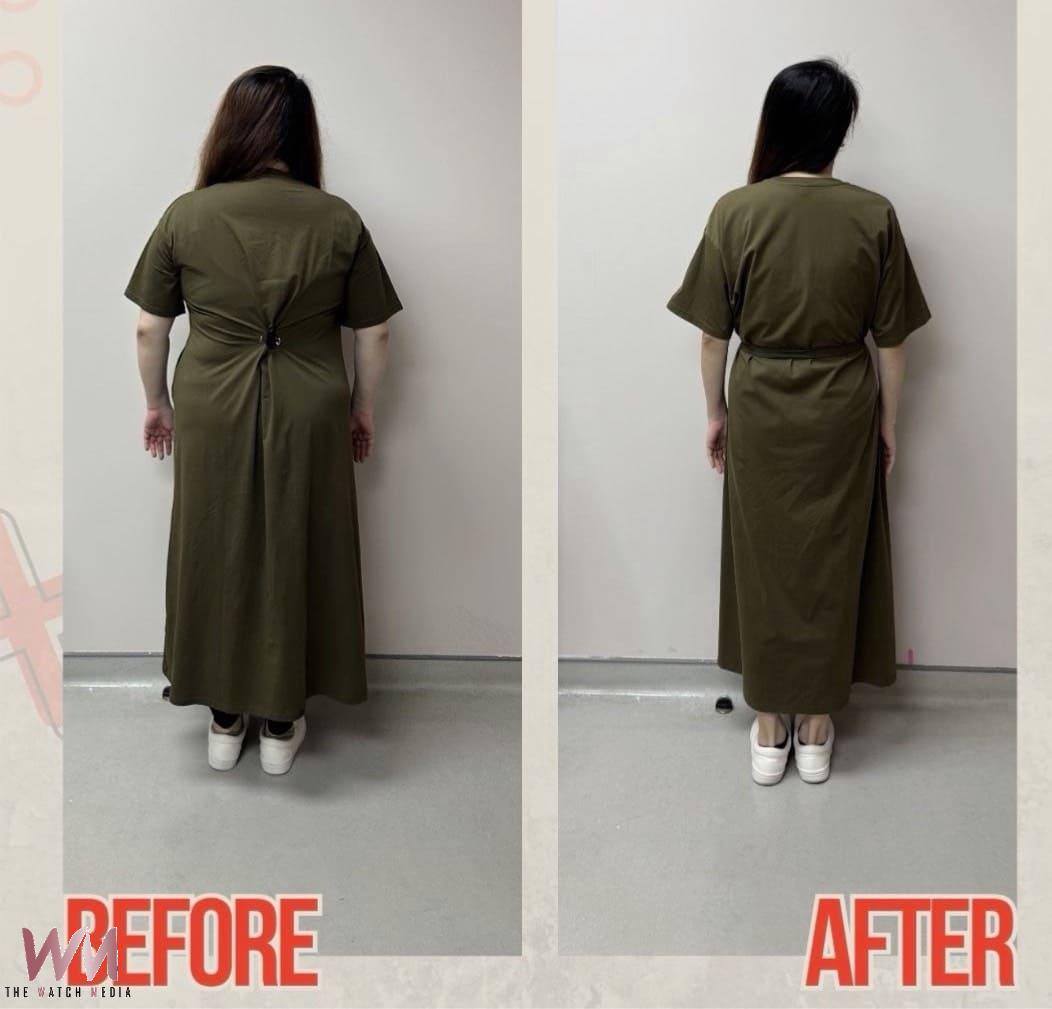 38歲女教師減重逾30公斤卻狂掉髮 醫提醒:瘦身別把營養也瘦掉 - https://www.watchmedia01.com