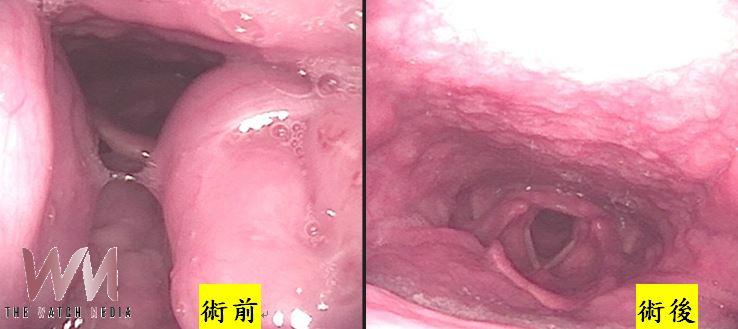 聲樂學生夜夜窒息打鼾致表現失常 達文西微創手術助重拾「中氣十足」 - https://www.watchmedia01.com
