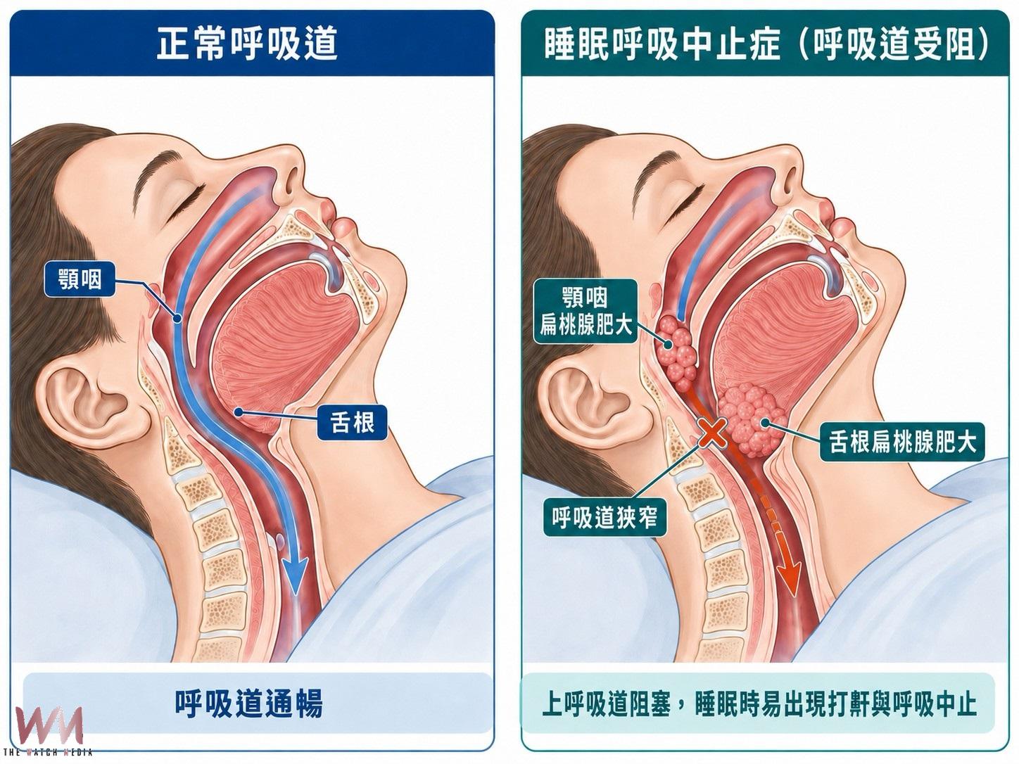 聲樂學生夜夜窒息打鼾致表現失常 達文西微創手術助重拾「中氣十足」 - https://www.watchmedia01.com