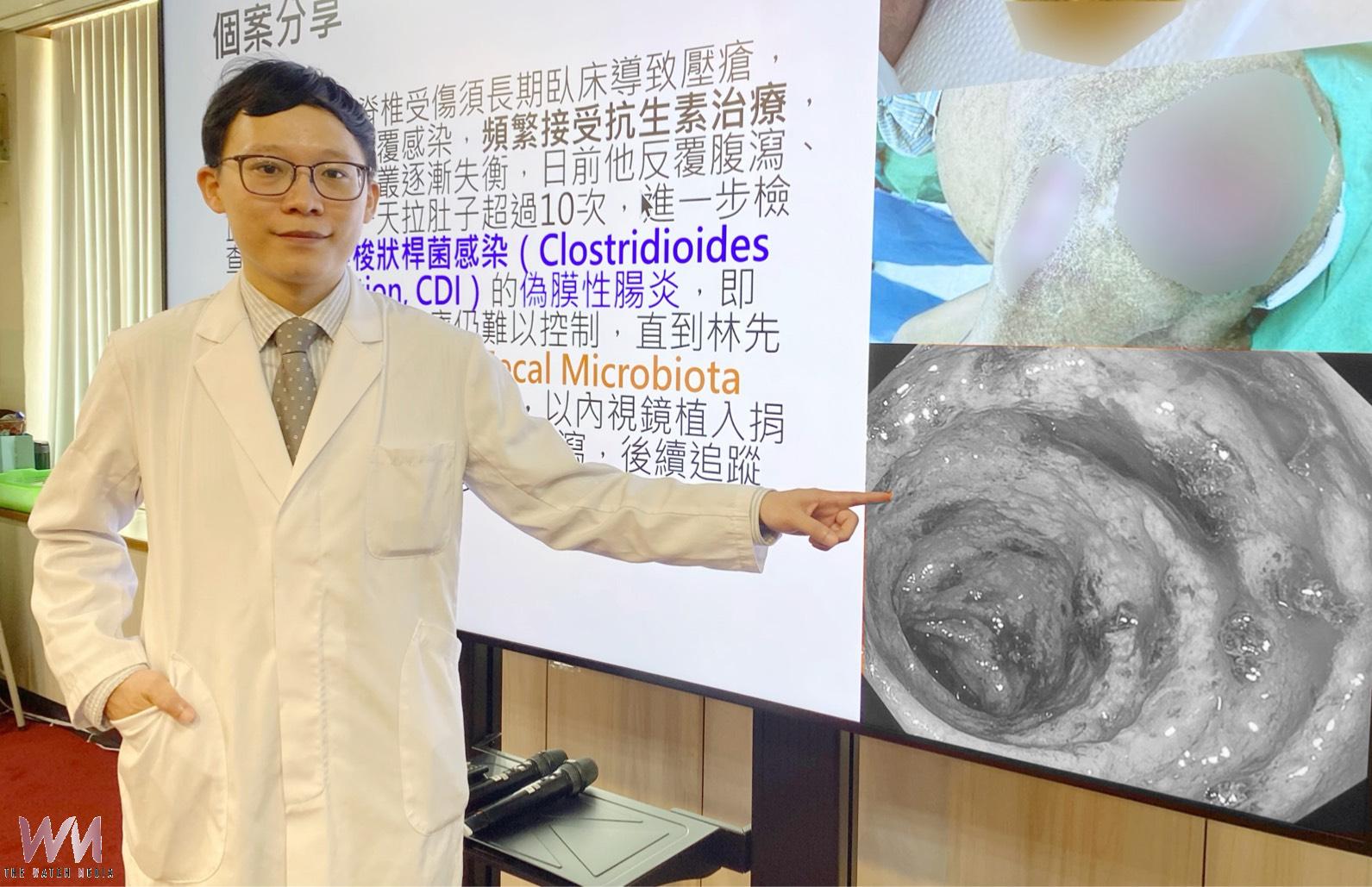 重拾乾爽生活　反覆腹瀉久治不癒 台中榮總：糞菌移植重建腸道健康 - https://www.watchmedia01.com