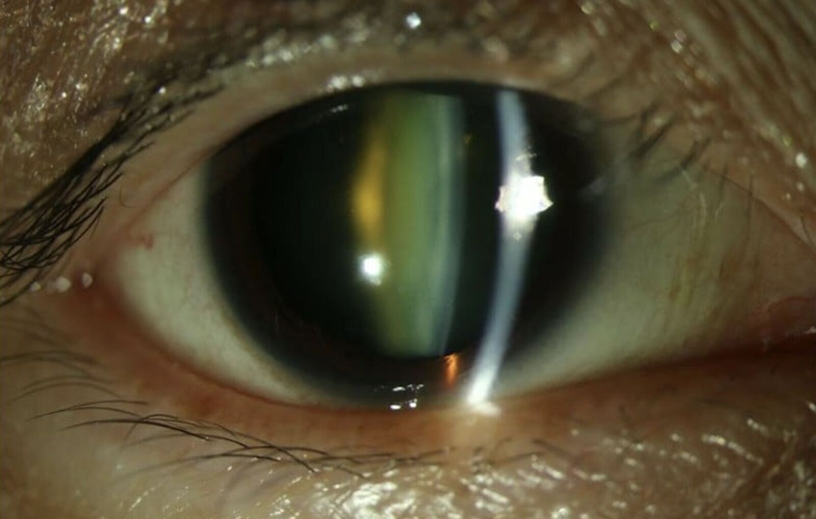 連換多副眼鏡仍看不清？ 眼冒「4大症狀」恐已白內障 185