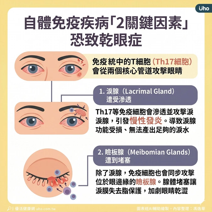 免疫疾病2因素導致乾眼症