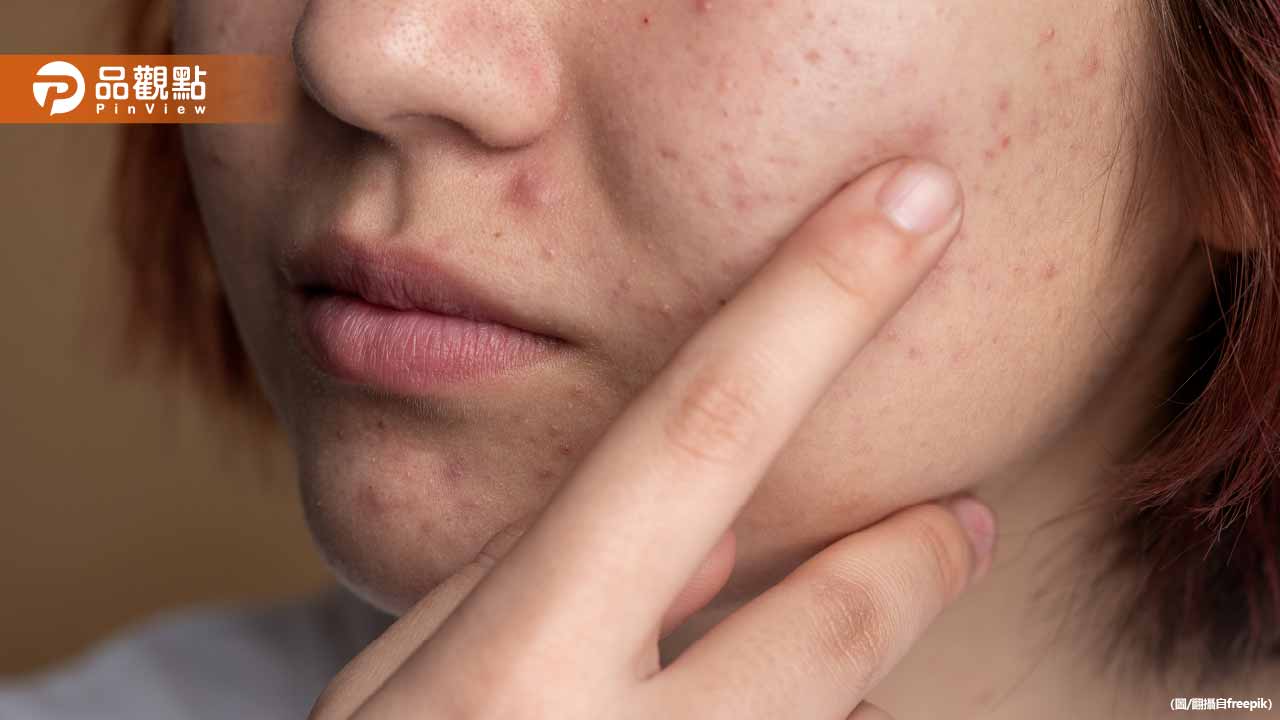 她臉上長痘痘自己擠壓拔膿栓、擦藥膏險毀容