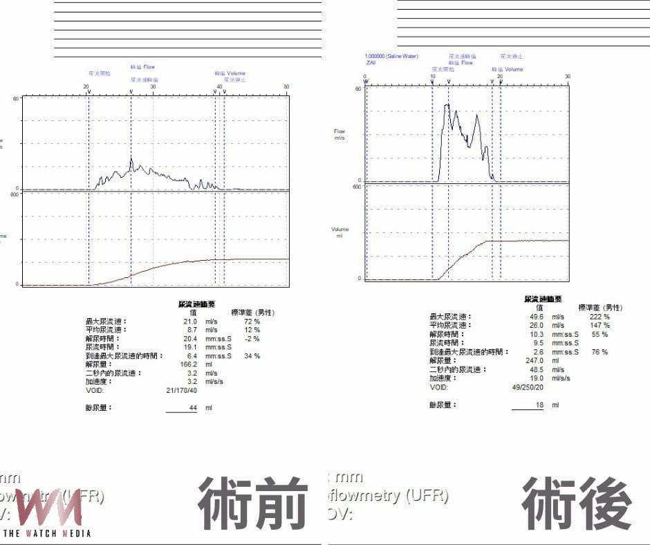 攝護腺肥大逾百克如拳頭 藍光雷射助6旬翁暢快解尿 擺脫不順夢魘 - https://www.watchmedia01.com