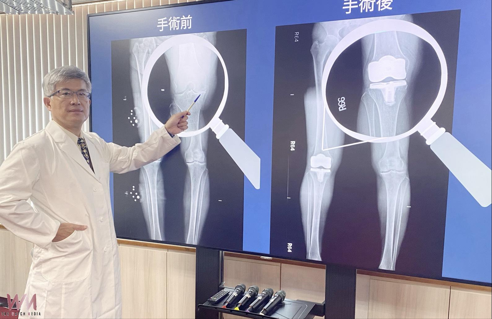 機械手臂精準置換手術 74歲女舞蹈老師換膝恢復日常重返舞台 - https://www.watchmedia01.com