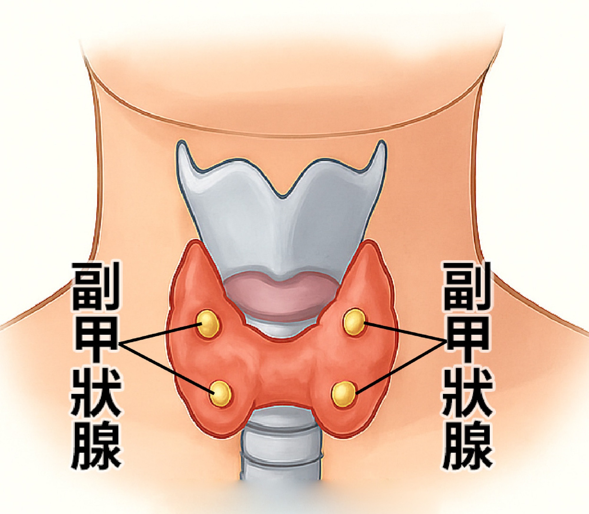腎結石頻復發、高血鈣警訊　副甲狀腺瘤恐是幕後元凶 - https://www.watchmedia01.com