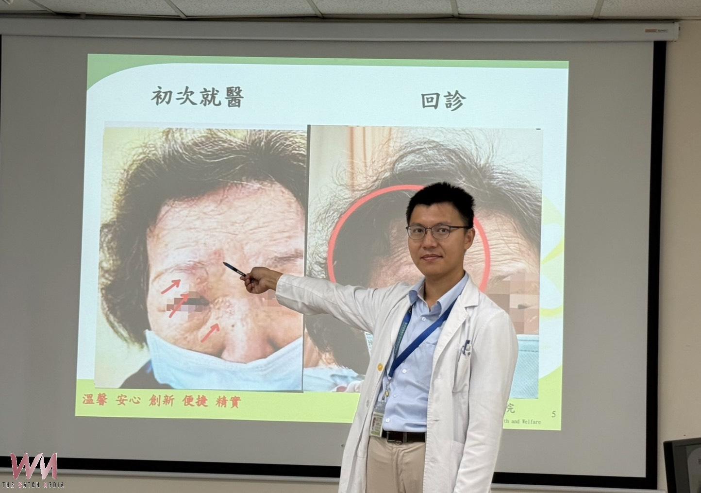 婦眼角冒水皰竟是「皮蛇」入侵　臺中醫院醫療團隊即時診治化解危機 - https://www.watchmedia01.com