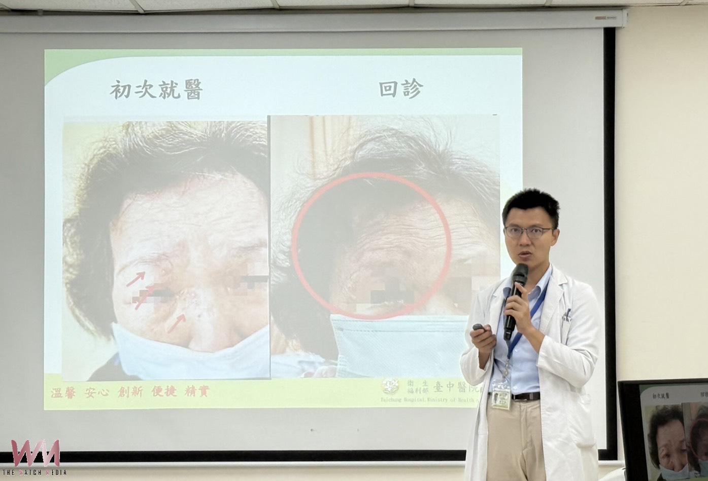 婦眼角冒水皰竟是「皮蛇」入侵　臺中醫院醫療團隊即時診治化解危機 - https://www.watchmedia01.com