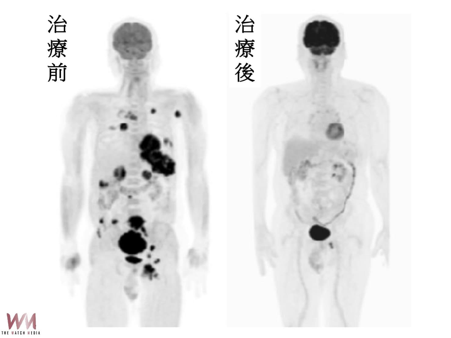 末期黑色素瘤患者存活10年見證療效 台癌籲善用百億基金救癌友 - https://www.watchmedia01.com