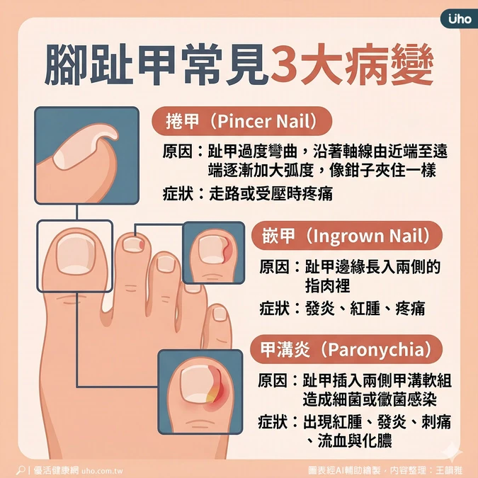 腳趾甲常見3大病變