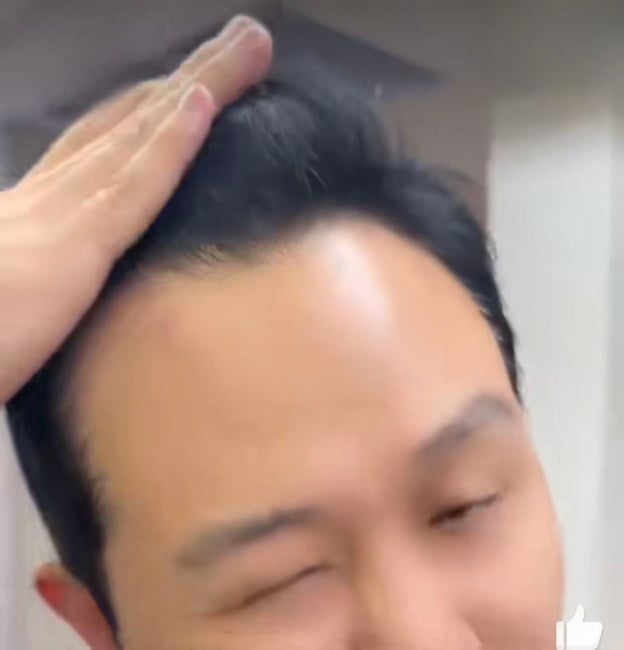 ▲遇劫當事人出示額頭被劫匪用槍抵住留下的紅印。