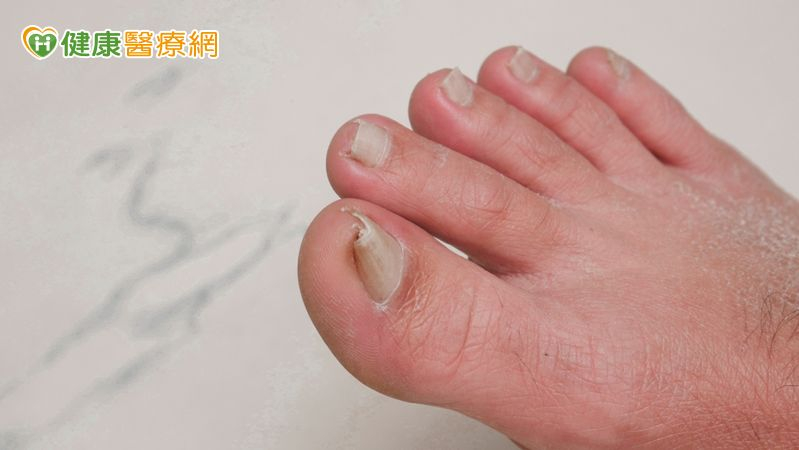 凍甲拔4次仍復發、「捲甲」痛到難穿鞋 甲床重建助甩寸步難行之苦