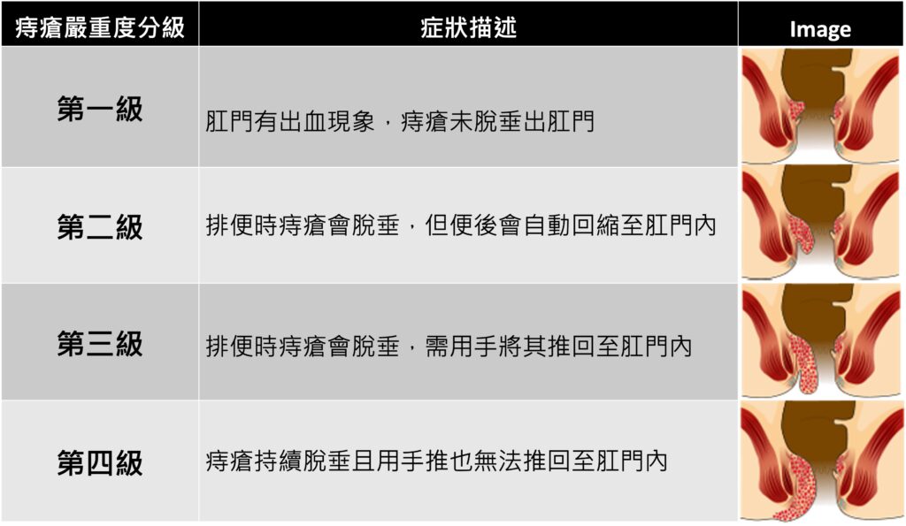 痔瘡反覆出血脫垂不用怕 最新微創雷射無限環技術邁入精準收縮無痛新紀元 42 %E5%9C%96%E7%89%87 1