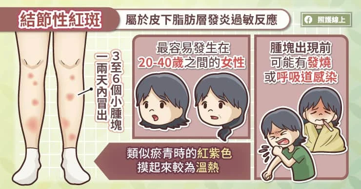 結節性紅斑的症狀