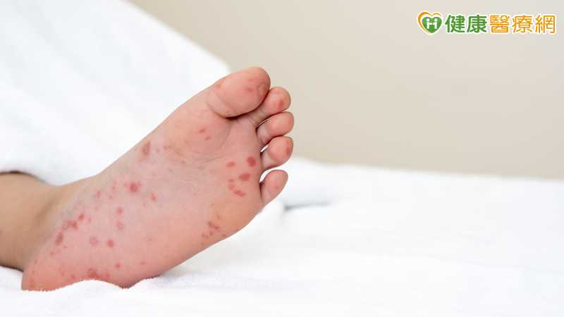 腸病毒疫情緩升增1重症！未滿5歲女童染D68型　8重症警訊須留意