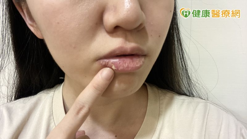 撕嘴皮撕到流血仍停不下來？醫揭可能與大腦1機制有關　當心是情緒警訊