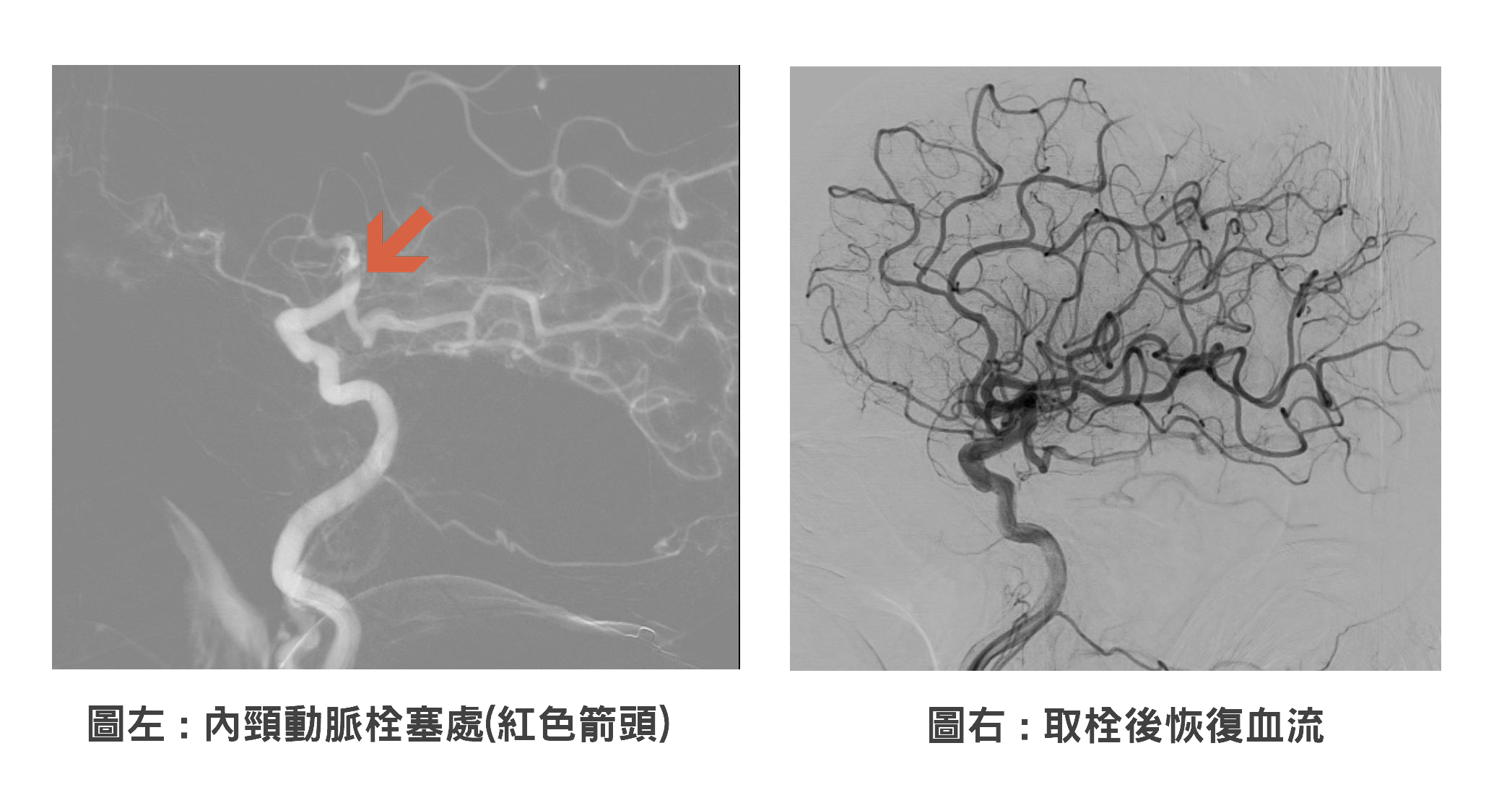 取栓前後對比照 0