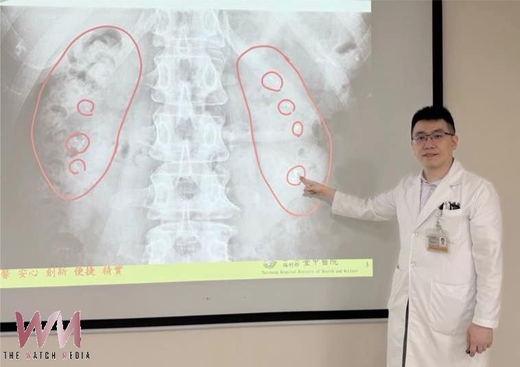 50歲婦女腎臟宛如長滿葡萄乾的雜糧麵包　原來是「雷氏斑」惹禍