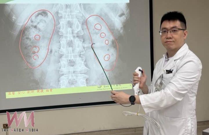 50歲婦女腎臟宛如長滿葡萄乾的雜糧麵包　原來是「雷氏斑」惹禍 - https://www.watchmedia01.com